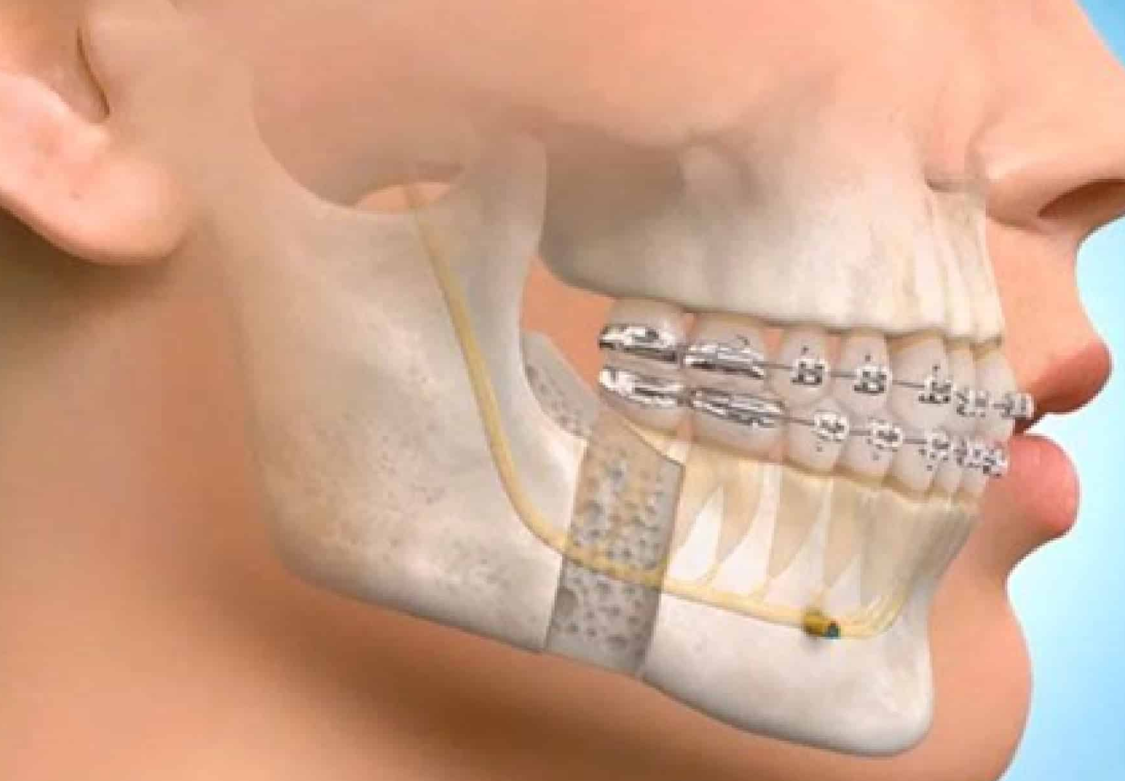 Faciomaxillary Surgery